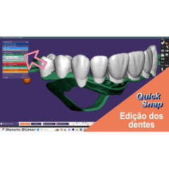 CURSO PPR DIGITAL QUICKSNAP EXOCAD - DENTES, GENGIVA E ESTRUTURA - HOTMART